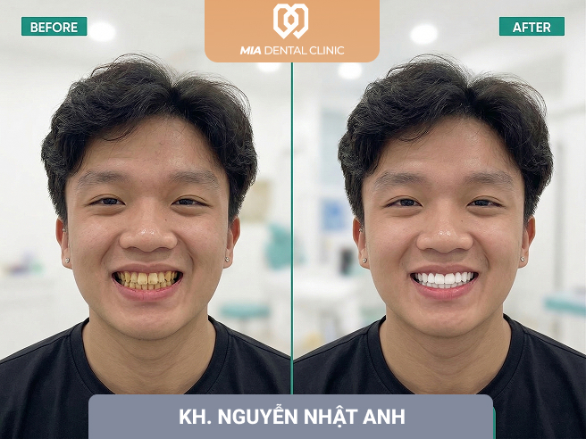 khách hàng bọc răng sứ 1