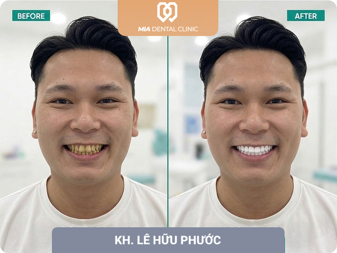 khách hàng bọc răng sứ 3