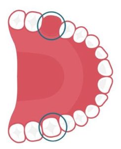 Trường hợp chỉ định trồng răng implant