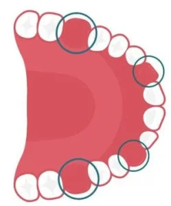 Trường hợp chỉ định trồng răng implant