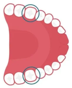 Trường hợp chỉ định trồng răng implant