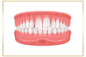 hình ảnh răng khấp khểnh